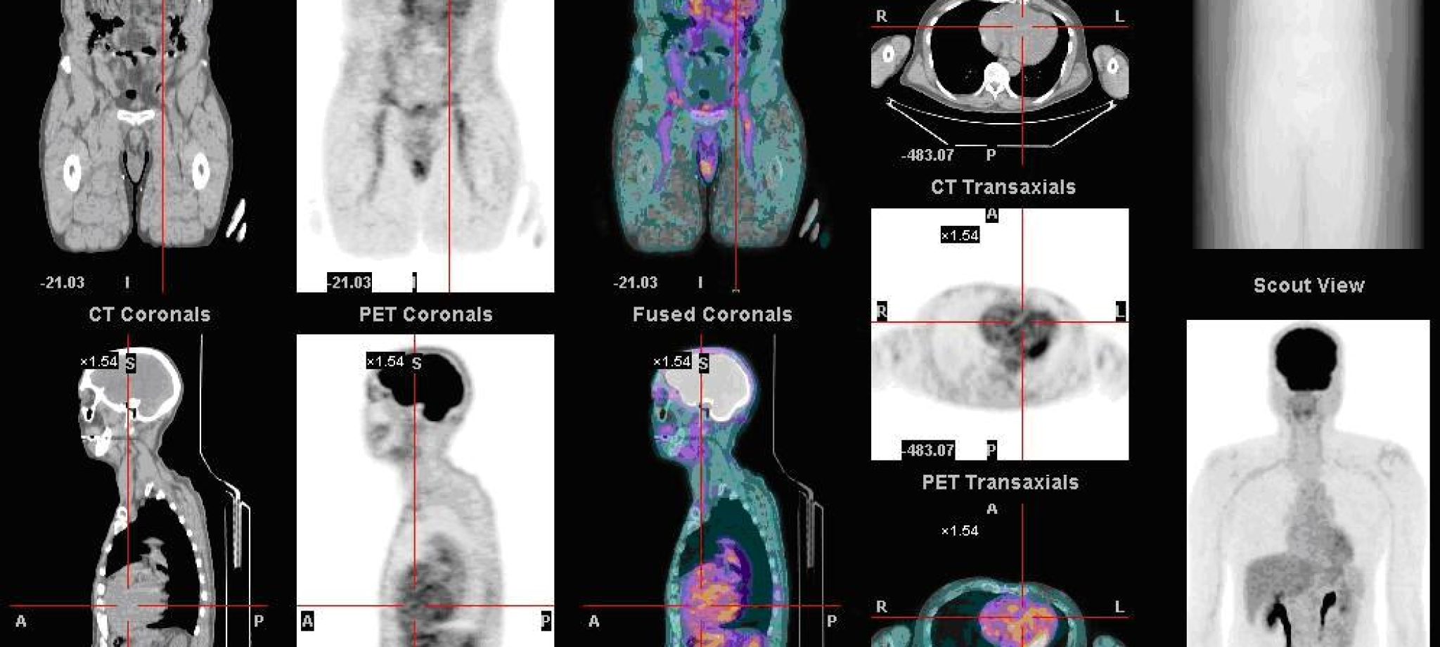 Nl_petct Nl_petct