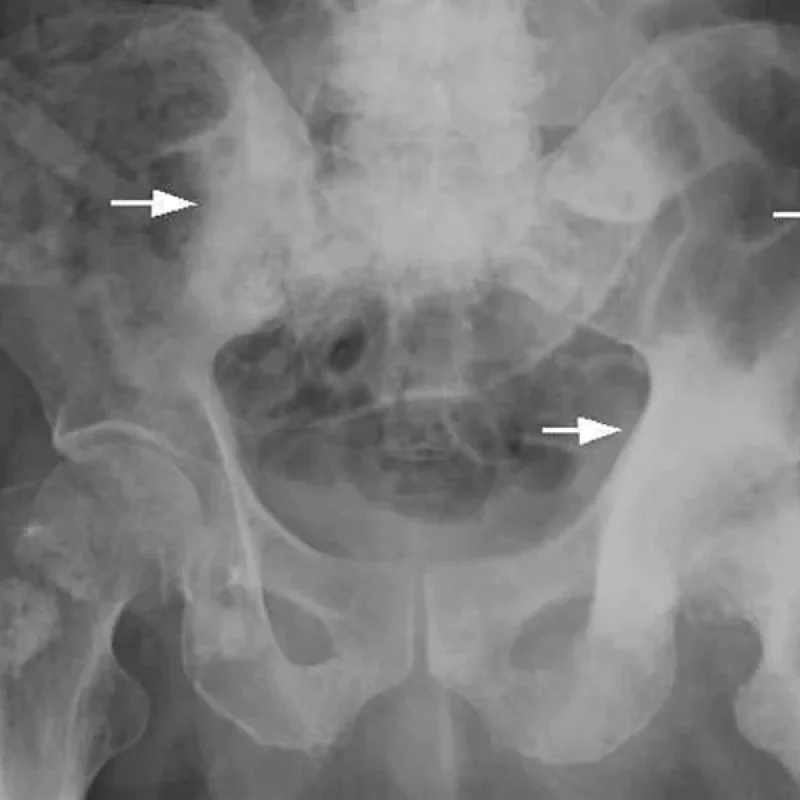 wc_171201_osteoplastic_bone_metastasis_prostate_cancer_800x600